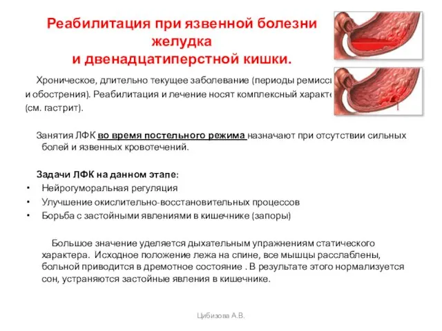 Реабилитация при язвенной болезни желудка и двенадцатиперстной кишки. Хроническое, длительно текущее