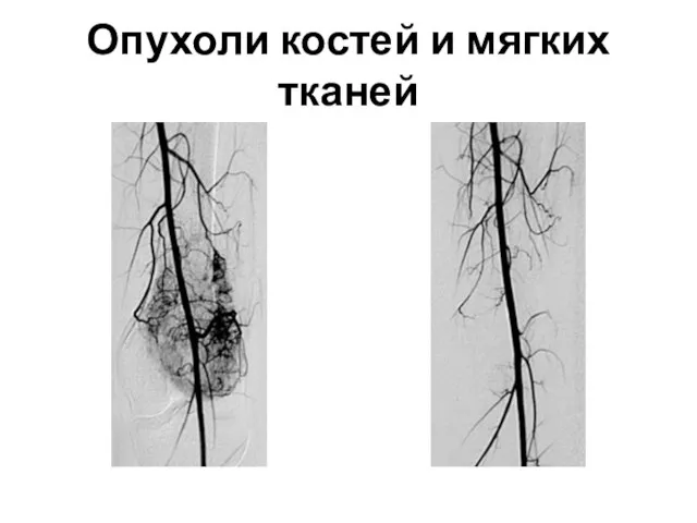 Опухоли костей и мягких тканей