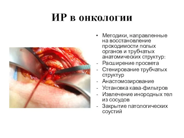 ИР в онкологии Методики, направленные на восстановление проходимости полых органов и