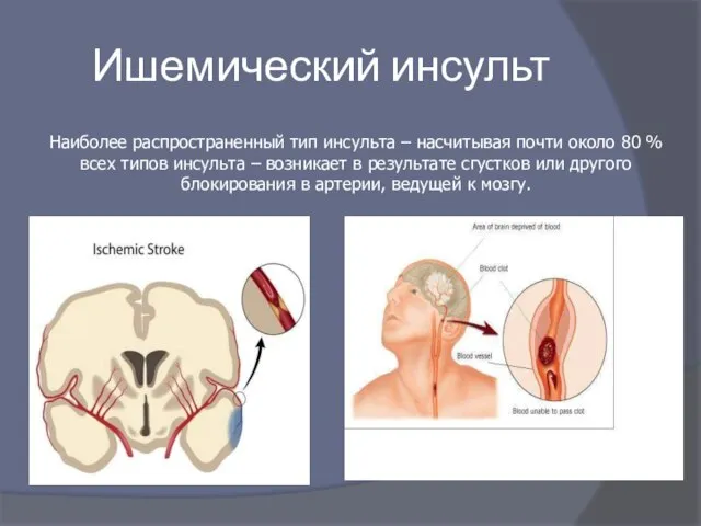 Ишемический инсульт Наиболее распространенный тип инсульта – насчитывая почти около 80