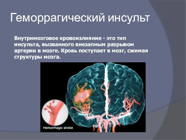 Геморрагический инсульт Внутримозговое кровоизлияние - это тип инсульта, вызванного внезапным разрывом