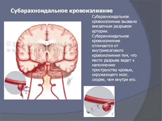 Субарахноидальное кровоизлияние вызвано внезапным разрывом артерии. Субарахноидальное кровоизлияние отличается от внутримозгового