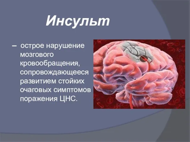 Инсульт – острое нарушение мозгового кровообращения, сопровождающееся развитием стойких очаговых симптомов поражения ЦНС.