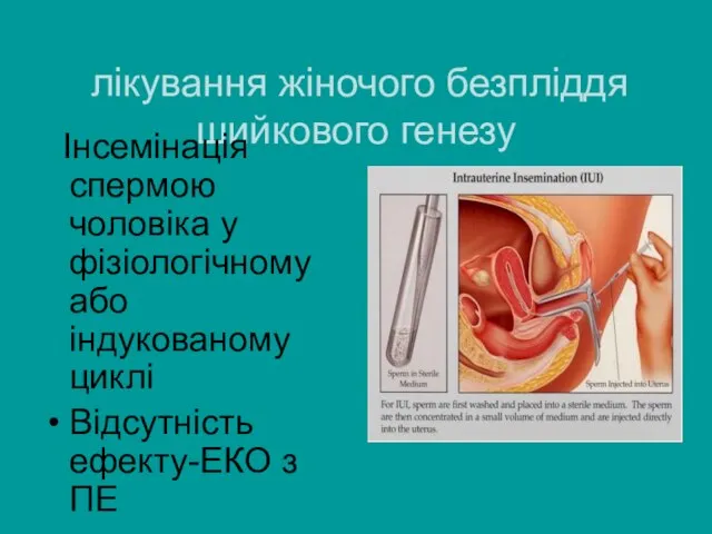 лікування жіночого безпліддя шийкового генезу Інсемінація спермою чоловіка у фізіологічному або