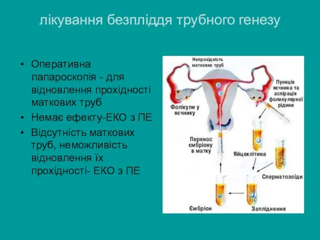 лікування безпліддя трубного генезу Оперативна лапароскопія - для відновлення прохідності маткових