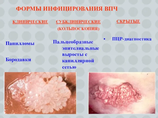 КЛИНИЧЕСКИЕ Папилломы Бородавки СУБКЛИНИЧЕСКИЕ (КОЛЬПОСКОПИЯ) Пальцеобразные эпителиальные выросты с капиллярной сетью ФОРМЫ ИНФИЦИРОВАНИЯ ВПЧ СКРЫТЫЕ ПЦР-диагностика