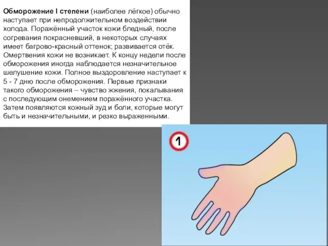 Обморожение I степени (наиболее лёгкое) обычно наступает при непродолжительном воздействии холода.