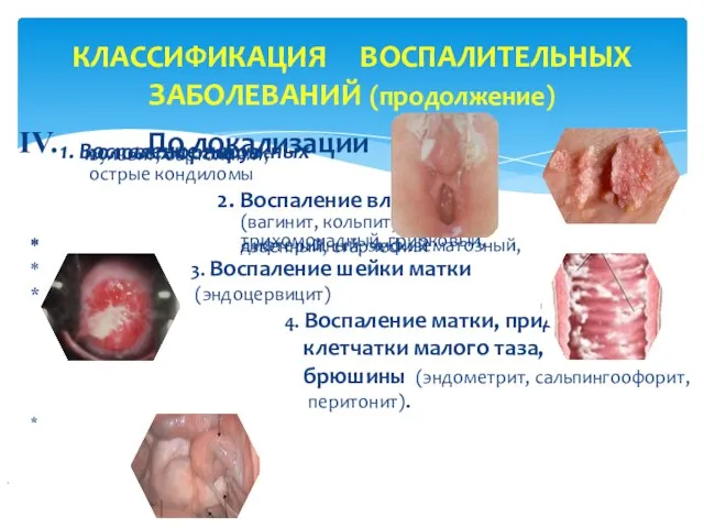 КЛАССИФИКАЦИЯ ВОСПАЛИТЕЛЬНЫХ ЗАБОЛЕВАНИЙ (продолжение) По локализации 1. Воспаление наружных половых органов