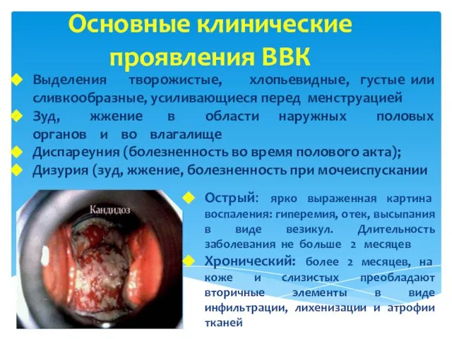 Основные клинические проявления ВВК Выделения творожистые, хлопьевидные, густые или сливкообразные, усиливающиеся