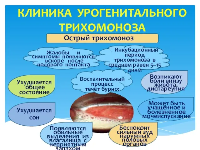 КЛИНИКА УРОГЕНИТАЛЬНОГО ТРИХОМОНОЗА Возникают боли внизу живота, диспареуния Острый трихомоноз Жалобы