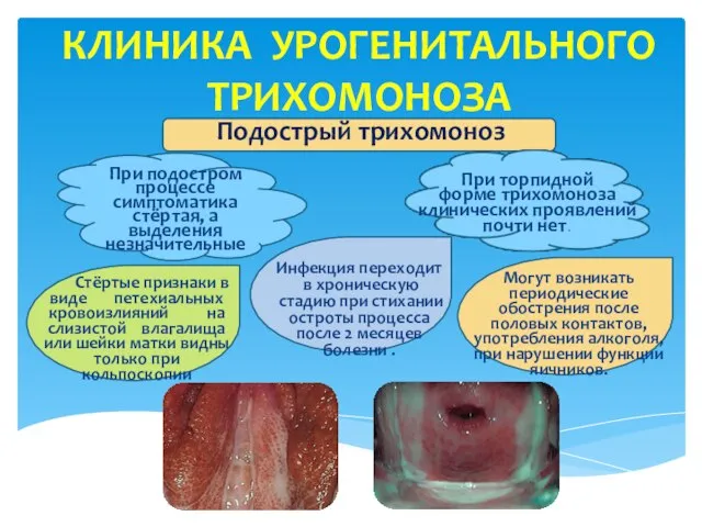 КЛИНИКА УРОГЕНИТАЛЬНОГО ТРИХОМОНОЗА При подостром процессе симптоматика стёртая, а выделения незначительные