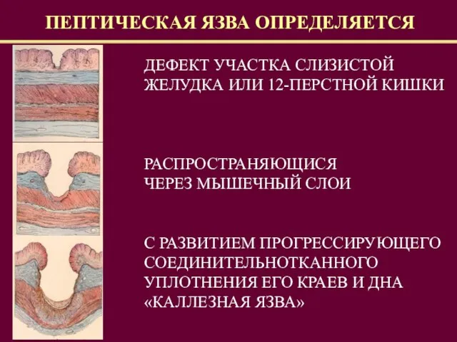 ПЕПТИЧЕСКАЯ ЯЗВА ОПРЕДЕЛЯЕТСЯ ДЕФЕКТ УЧАСТКА СЛИЗИСТОЙ ЖЕЛУДКА ИЛИ 12-ПЕРСТНОЙ КИШКИ РАСПРОСТРАНЯЮЩИСЯ