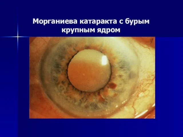 Морганиева катаракта с бурым крупным ядром