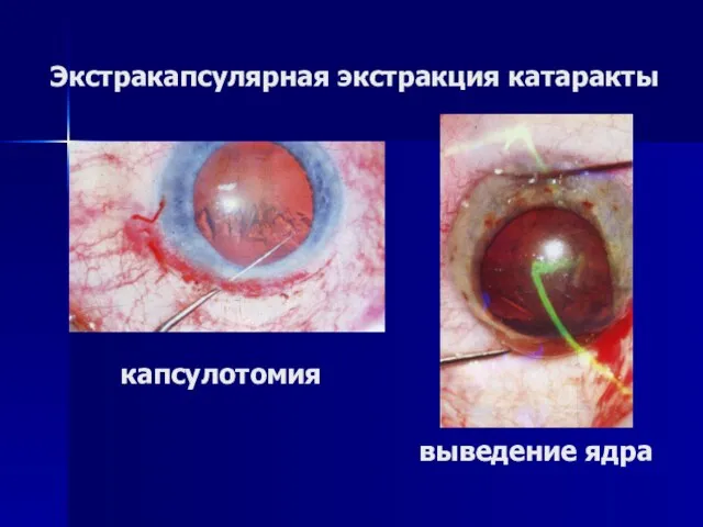 Экстракапсулярная экстракция катаракты капсулотомия выведение ядра