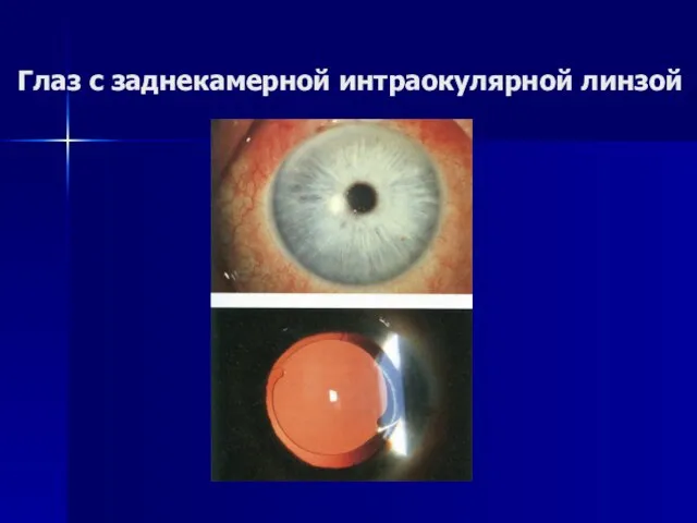 Глаз с заднекамерной интраокулярной линзой