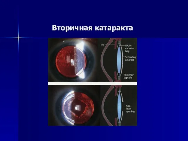 Вторичная катаракта