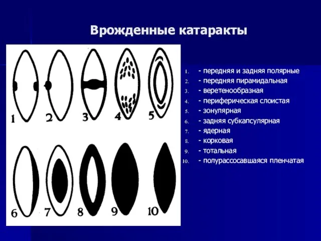 Врожденные катаракты - передняя и задняя полярные - передняя пирамидальная -