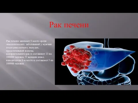 Рак печени занимает 5-место среди онкологических заболеваний у мужчин после рака