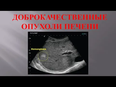 ДОБРОКАЧЕСТВЕННЫЕ ОПУХОЛИ ПЕЧЕНИ