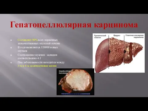 Гепатоцеллюлярная карцинома Составляет 90% всех первичных злокачественных опухолей печени В годя