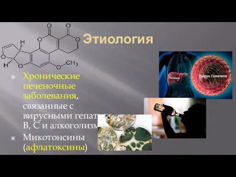 Этиология Хронические печеночные заболевания, связанные с вирусными гепатита В, С и алкоголизмом Микотонсины (афлатоксины)