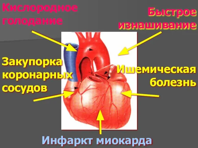 Быстрое изнашивание Закупорка коронарных сосудов Инфаркт миокарда Ишемическая болезнь Кислородное голодание