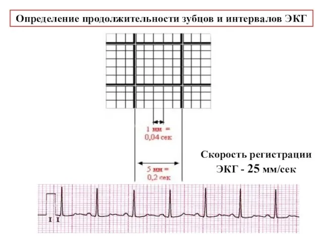 Скорость регистрации ЭКГ - 25 мм/сек Определение продолжительности зубцов и интервалов ЭКГ