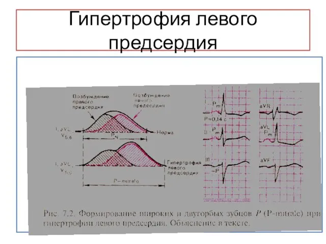 Гипертрофия левого предсердия