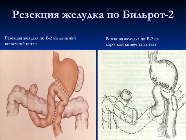 Резекция желудка по Бильрот-2 Резекция желудка по Б-2 на длинной кишечной