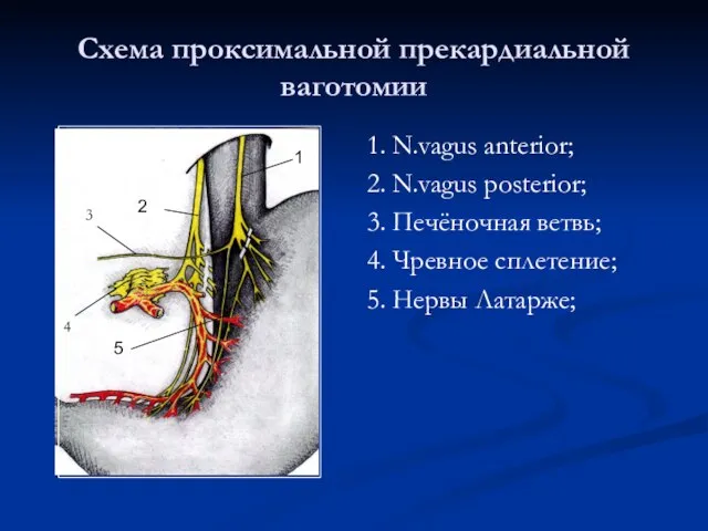 Схема проксимальной прекардиальной ваготомии 1. N.vagus anterior; 2. N.vagus posterior; 3.