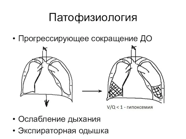 Патофизиология Прогрессирующее сокращение ДО Ослабление дыхания Экспираторная одышка