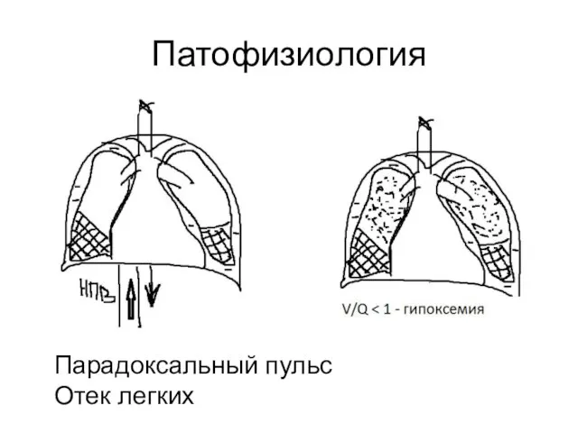 Патофизиология Парадоксальный пульс Отек легких