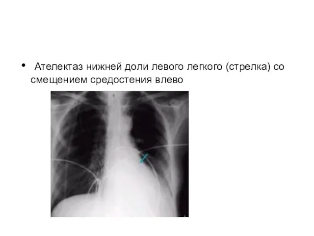 Ателектаз нижней доли левого легкого (стрелка) со смещением средостения влево