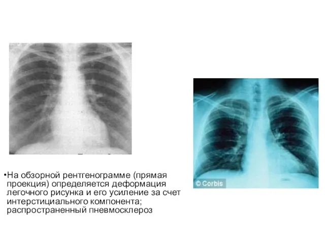 На обзорной рентгенограмме (прямая проекция) определяется деформация легочного рисунка и его