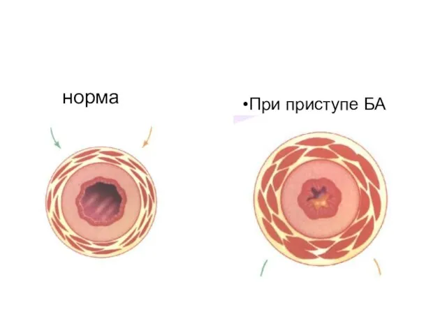 норма При приступе БА