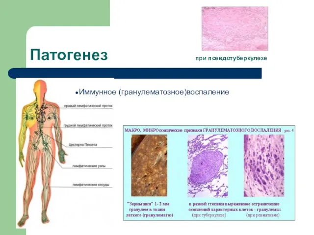 Патогенез при псевдотуберкулезе Иммунное (гранулематозное)воспаление