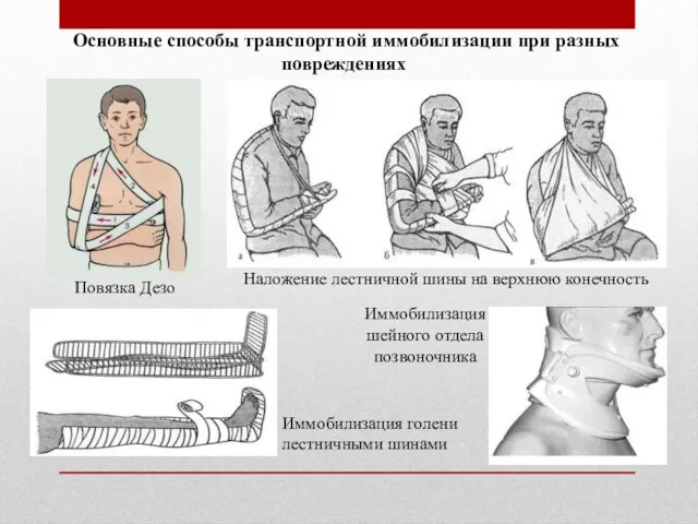 Основные способы транспортной иммобилизации при разных повреждениях Повязка Дезо Наложение лестничной