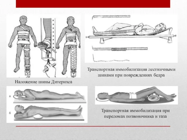 Наложение шины Дитерихса Транспортная иммобилизация лестничными шинами при повреждениях бедра Транспортная