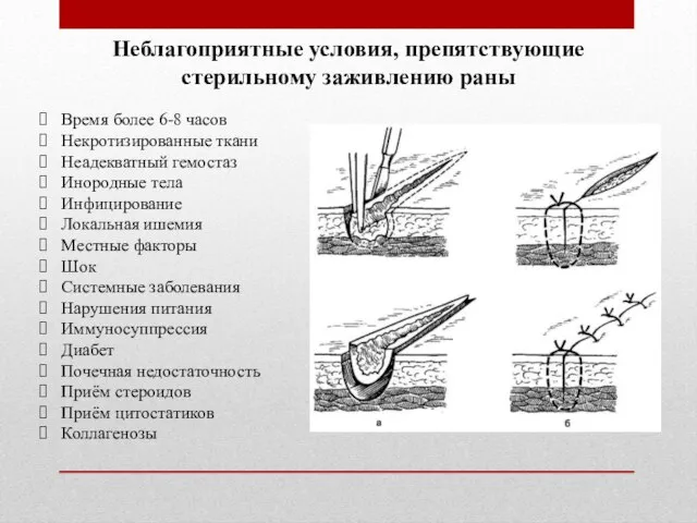 Неблагоприятные условия, препятствующие стерильному заживлению раны Время более 6-8 часов Некротизированные