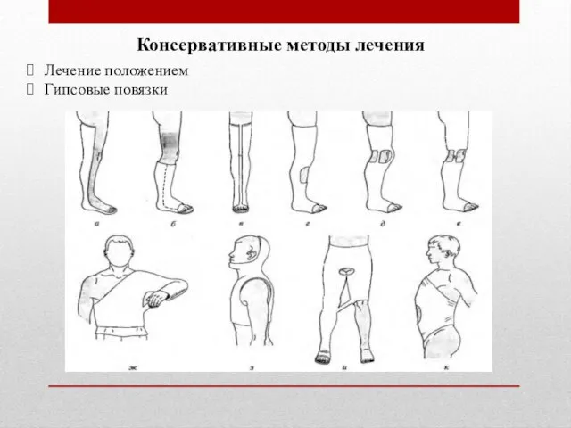 Консервативные методы лечения Лечение положением Гипсовые повязки