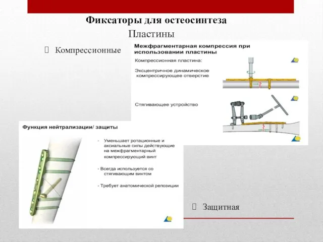 Фиксаторы для остеосинтеза Пластины Защитная Компрессионные