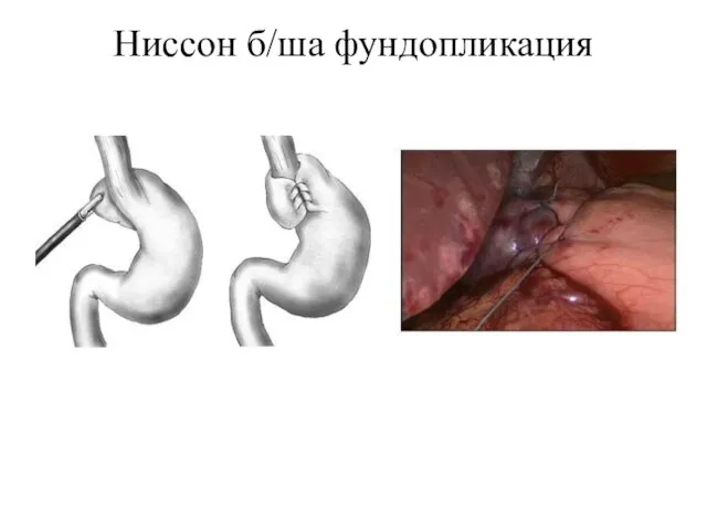 Ниссон б/ша фундопликация