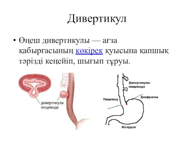 Дивертикул Өңеш дивертикулы — ағза қабырғасының көкірек қуысына қапшық тәрізді кеңейіп, шығып тұруы.