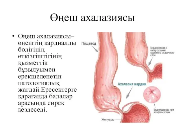 Өңеш ахалазиясы Өңеш ахалазиясы– өңештің кардиалды бөлігінің өткізгіштігінің қызметтік бұзылуымен ерекшеленетін