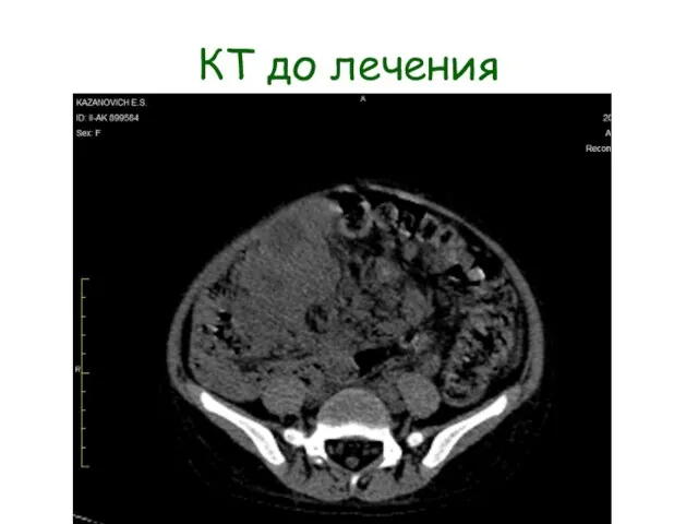 КТ до лечения