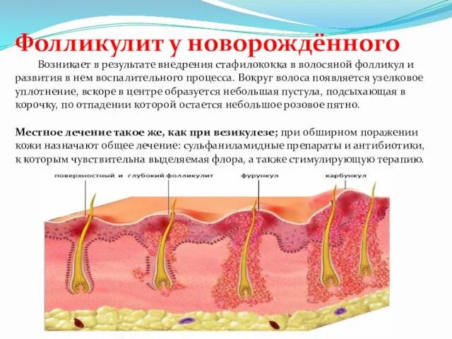 Фолликулит у новорождённого Возникает в результате внедрения стафилококка в волосяной фолликул