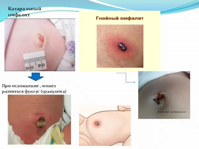 Катаральный омфалит При осложнение , может развиться фунгус (гранулема)