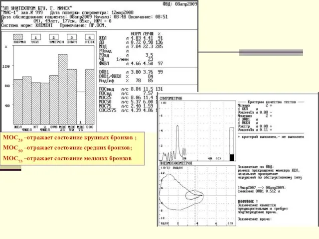 МОС25 –отражает состояние крупных бронхов ; МОС50 –отражает состояние средних бронхов; МОС75 –отражает состояние мелкихх бронхов