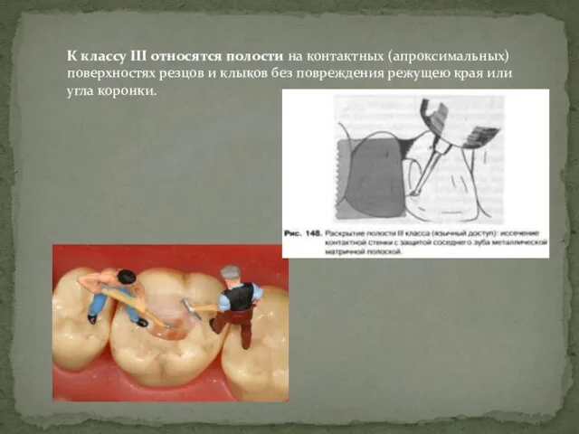 К классу III относятся полости на контактных (апроксимальных) поверхностях резцов и