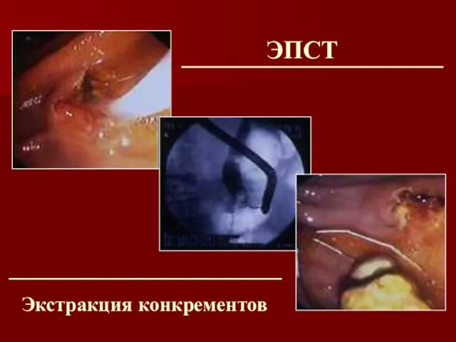 ЭПСТ Экстракция конкрементов